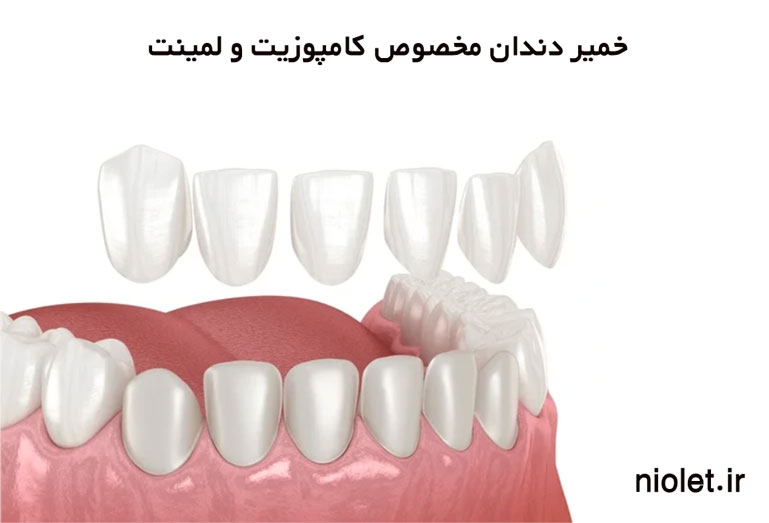 خمیر دندان کامپوزیت ونیر لمینت کانفیدنت