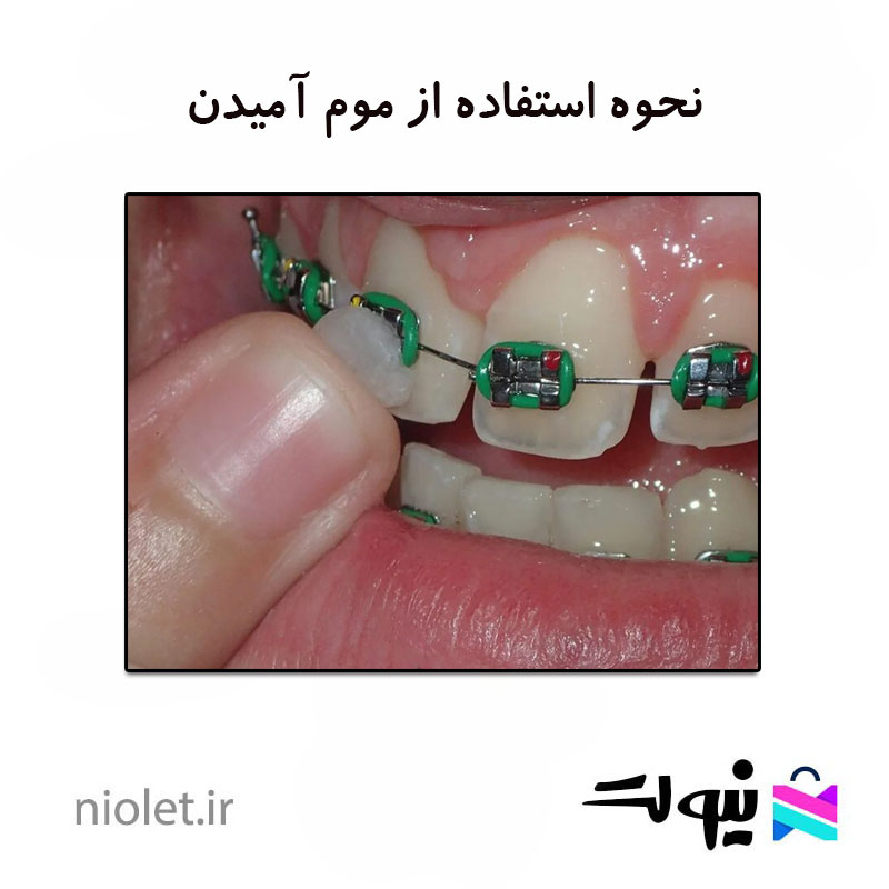 موم ارتودنسی آمیدن amiden
